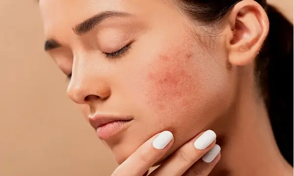 Piel con imperfecciones Remedios caseros para un cutis uniforme